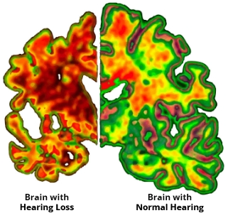Brain MRI Hearing Loss vs Aided